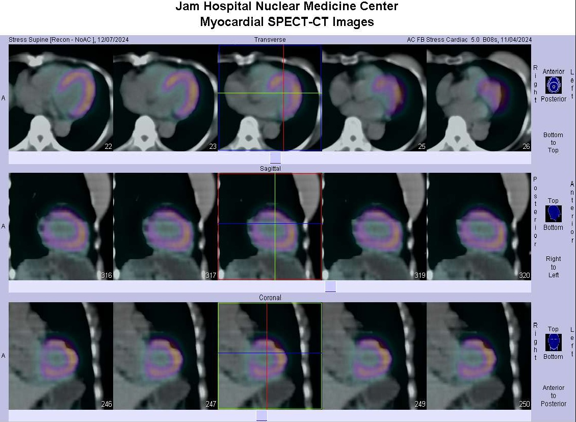 Myocardial SPECT-CT